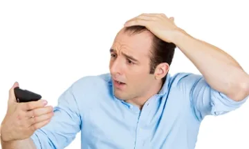 The bald truth of men losing hair in their 20s