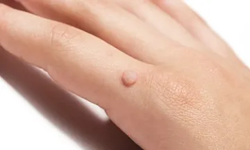 What are Genital Warts?