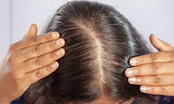 Female Pattern Baldness Symptoms