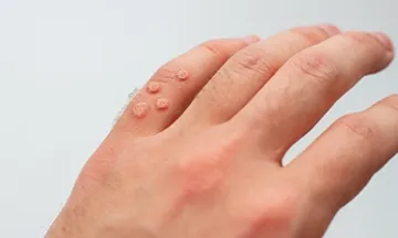 skin-diseaseswartscauses