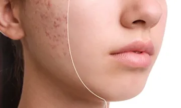 10 things you can do to treat acne