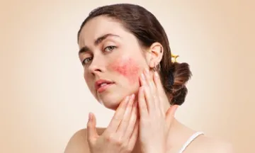 Rosacea vs Acne: How to Distinguish and Treat Each Condition