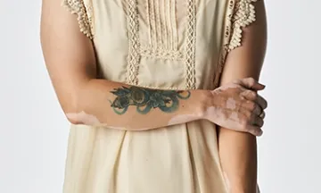 Is It Safe to Get a Tattoo If You Have Vitiligo?