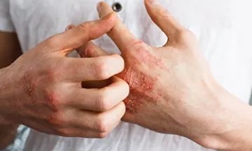 Dermatitis