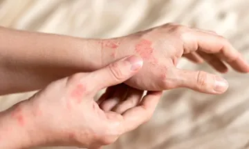 Eczema Types: Understanding the 7 Common Forms & Their Symptoms