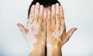 Symptoms of Vitiligo – Identifying the Early Signs