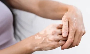 Skincare tips if you have vitiligo