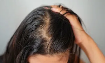 Stages of Female Pattern Baldness: Causes, Symptoms & Treatments