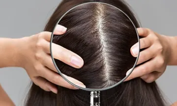 Non surgical Hair Replacement Treatment