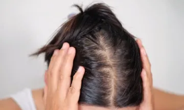 Reasons for hair thinning