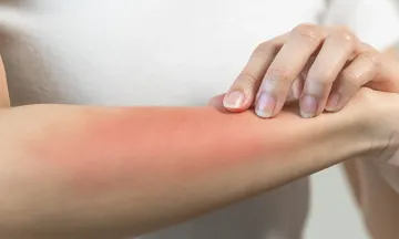 Treat Summer Skin Problems with Homeopathy