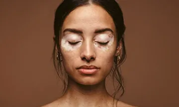 Understanding Vitiligo in Children