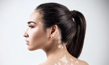 Vitiligo and Thyroid Connection: Understanding the Link