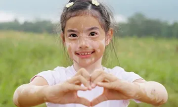 Is Vitiligo Hereditary?