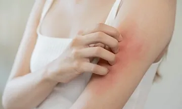 Watch Out for These Monsoon Skin Diseases