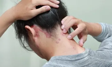 What causes Psoriasis of the scalp?