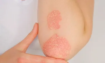 Best Treatment for Psoriasis: Effective Solutions for Clear Skin