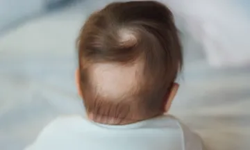 Alopecia Areata in Children - Signs & Treatment
