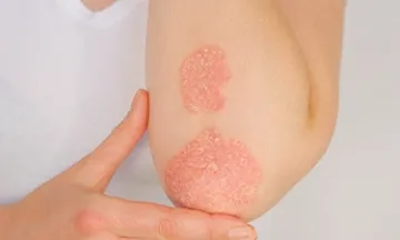 Is psoriasis an autoimmune disease?