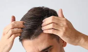 seborrhoeic-dermatitissymptoms