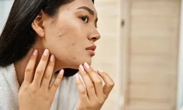 skin-diseasesacnetypes