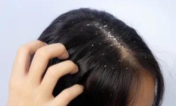 types-of-dandruff