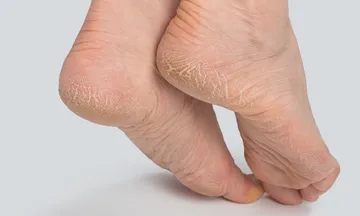 Homeopathy… A good solution for Cracked Heels