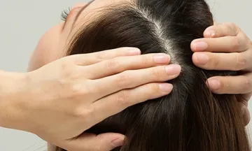Female Pattern Baldness in 20s – Causes, Symptoms & Best Treatments