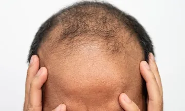 Can Alopecia Areata Turn Into Totalis?