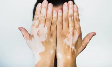 Is It Safe to Get a Tattoo If You Have Vitiligo?