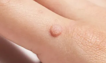 What are Genital Warts?