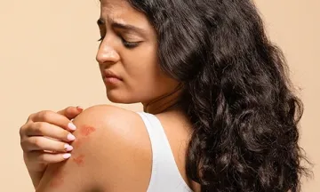 Epsom Salt for Psoriasis: Benefits & Soothing Baths