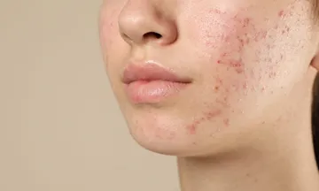 post summer pigmentation