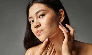 Acne in women after 30
