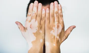 difference vitiligo white patch