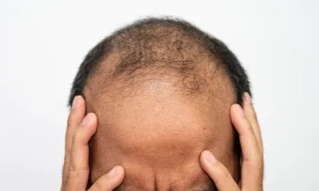 hair loss in man