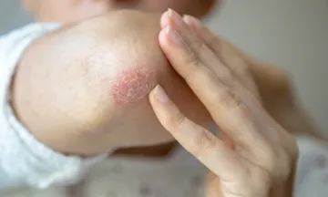 monsoon skin problems