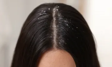 Homeopathic Medicine Helped My Scalp