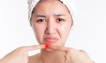 Acne vs Eczema
