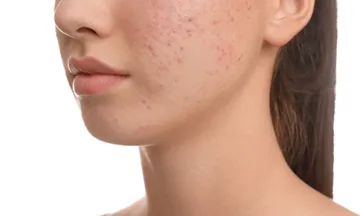 Acne