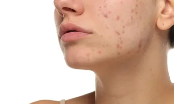 Are acne scars more than skin