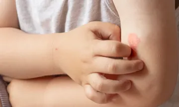Atopic Dermatitis