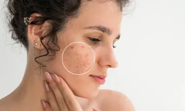 Best Remedy for Acne