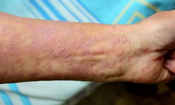 Freedom from lesions of Lichen Planus