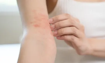 Get rid of itchy skin