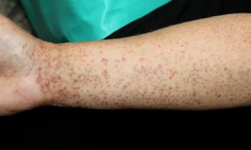 Heal your Lichen Planus
