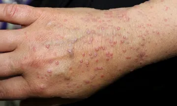 How long does lichen planus take to clear up