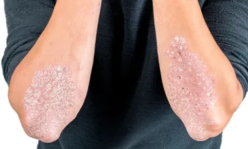 Is psoriasis hereditary