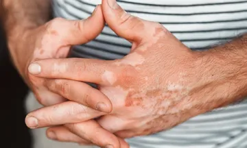 Leucoderma