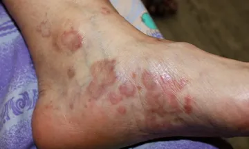 Lichen Planus & Depression